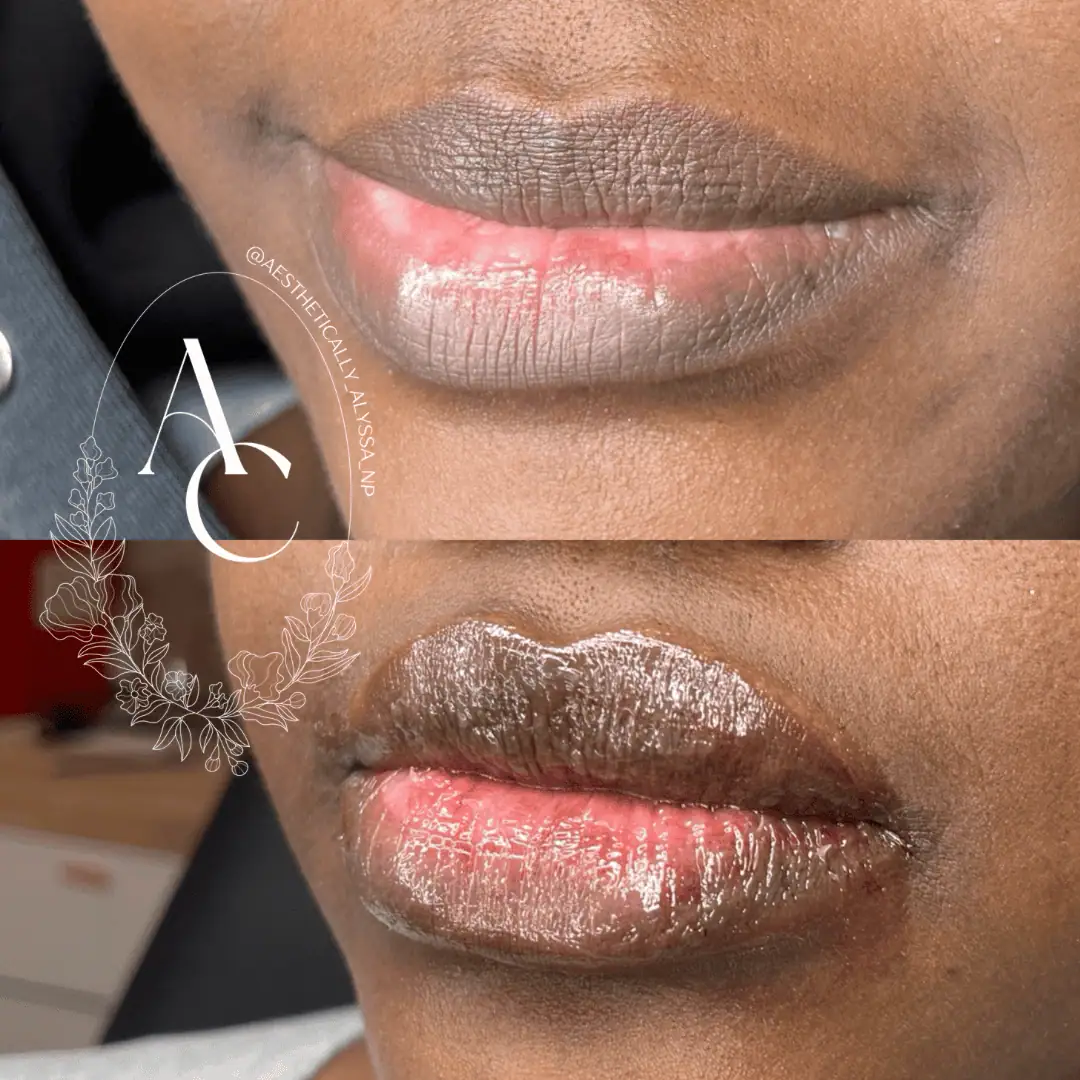 Lip-Filler-before-after-twentyfive-in-New-York