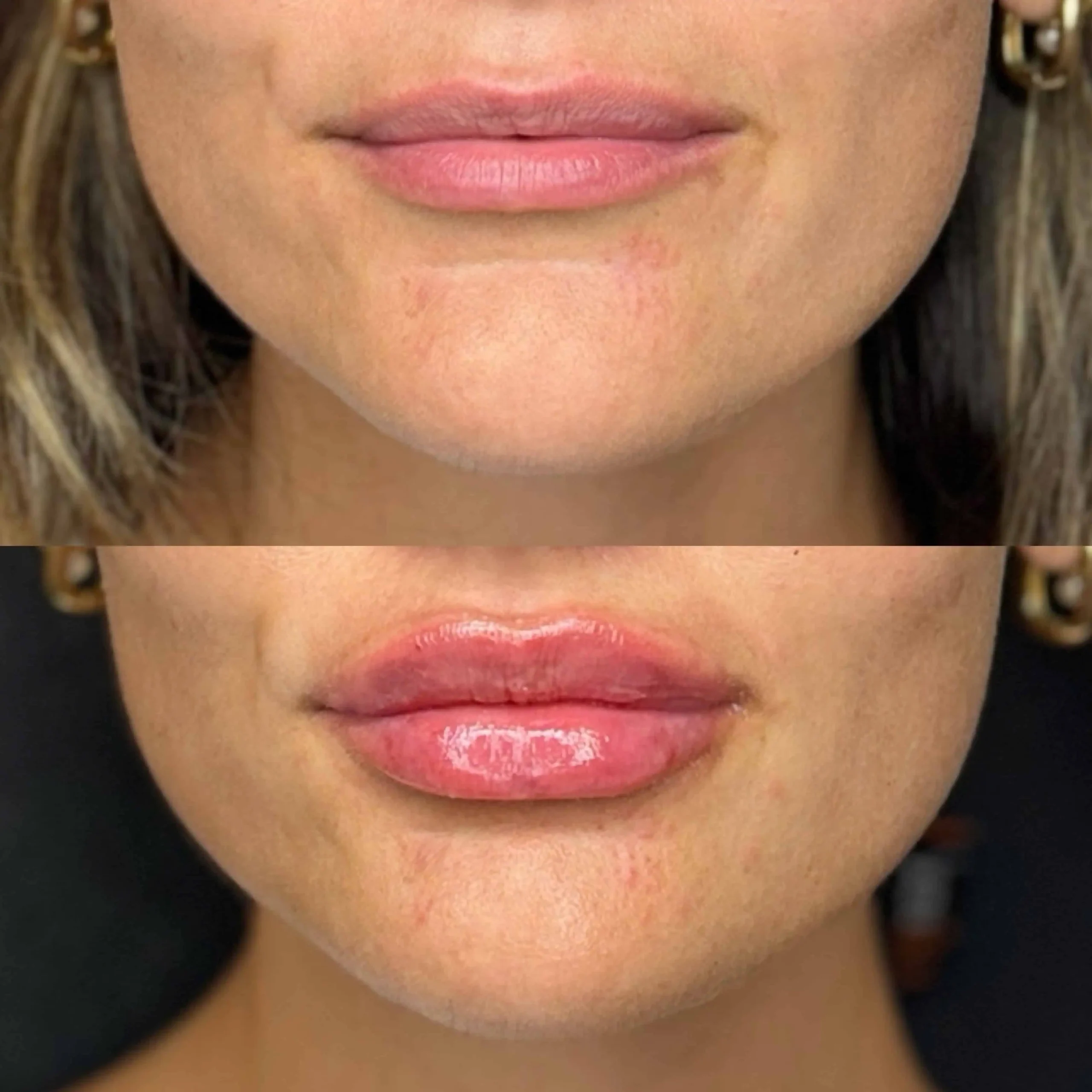 Lip-Filler-before-after-twentyseven-in-New-York