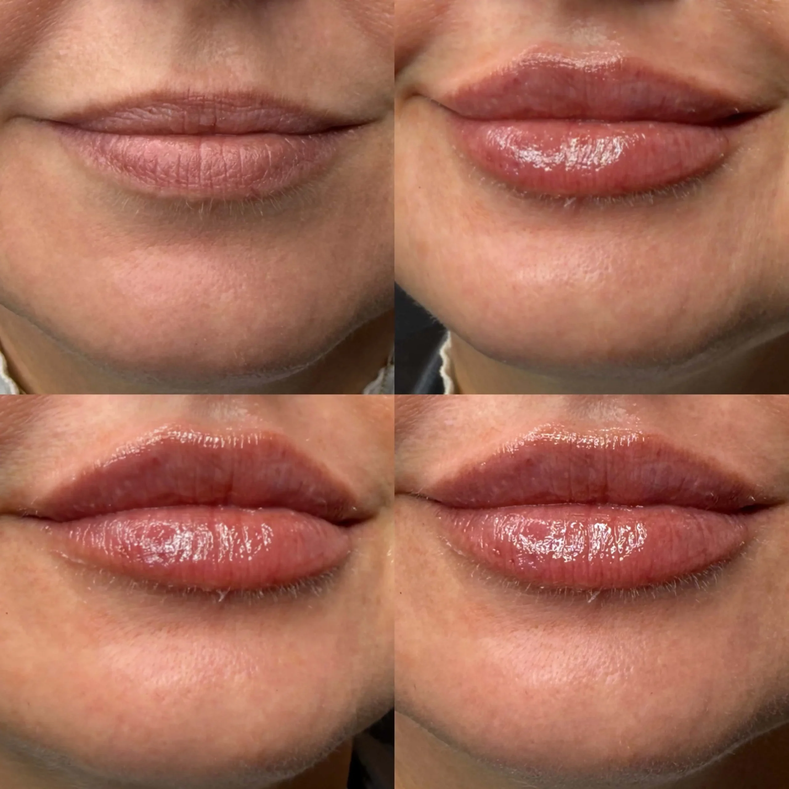 Lip-Filler-before-after-twentysix-in-New-York