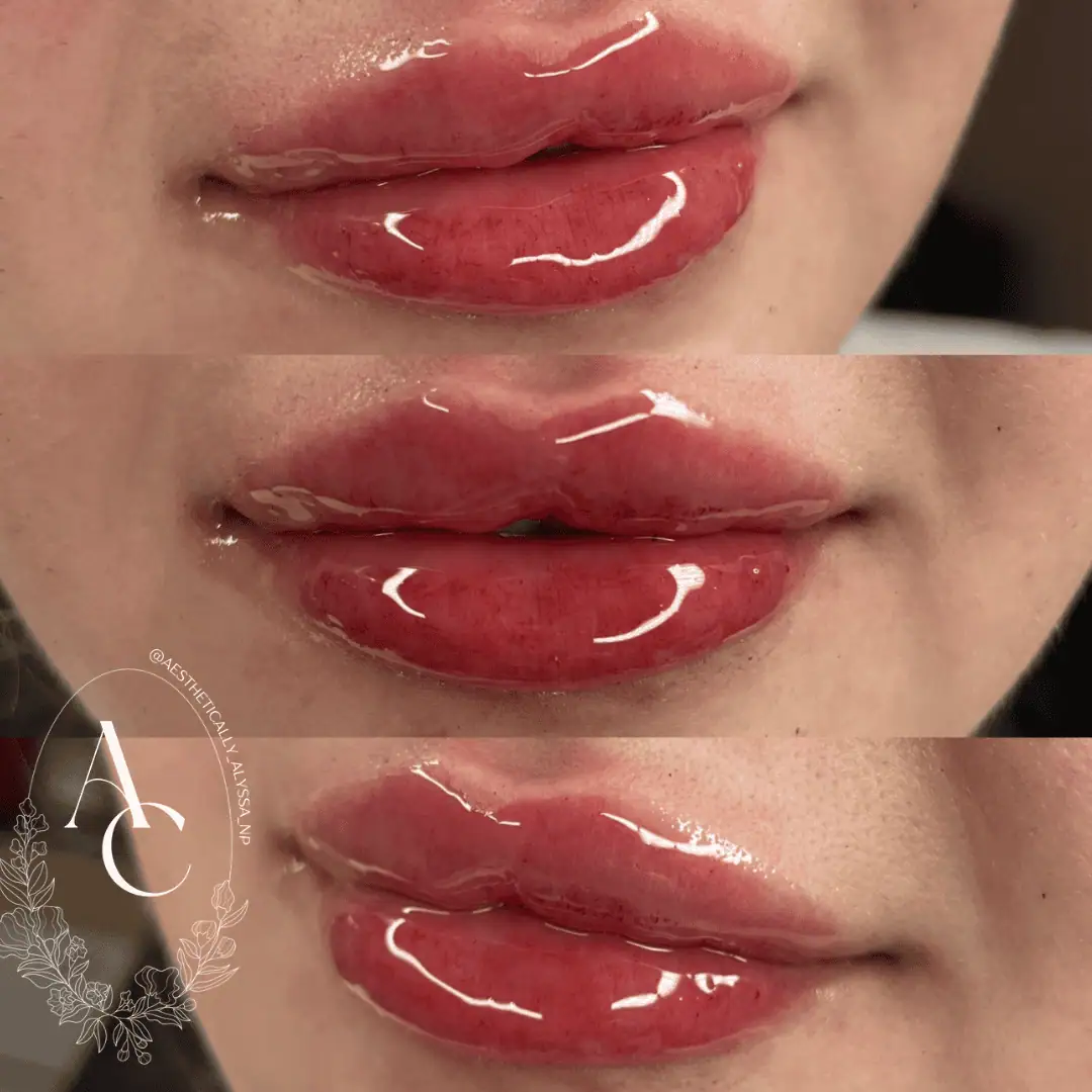 Lip-Filler-before-after-two-in-New-York