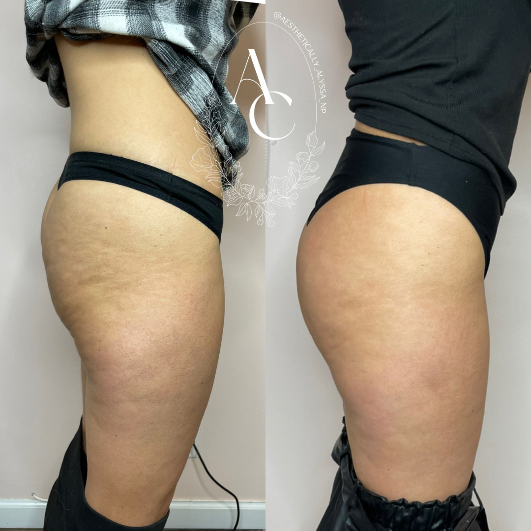 Nonsurgical-BBL-before-after-five-in-New-York
