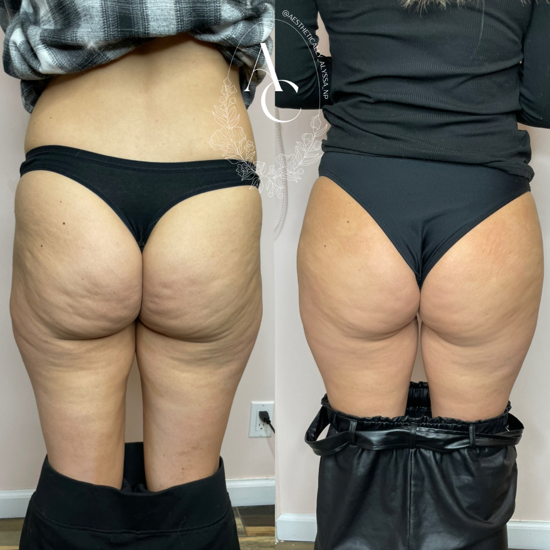 Nonsurgical-BBL-before-after-two-in-New-York