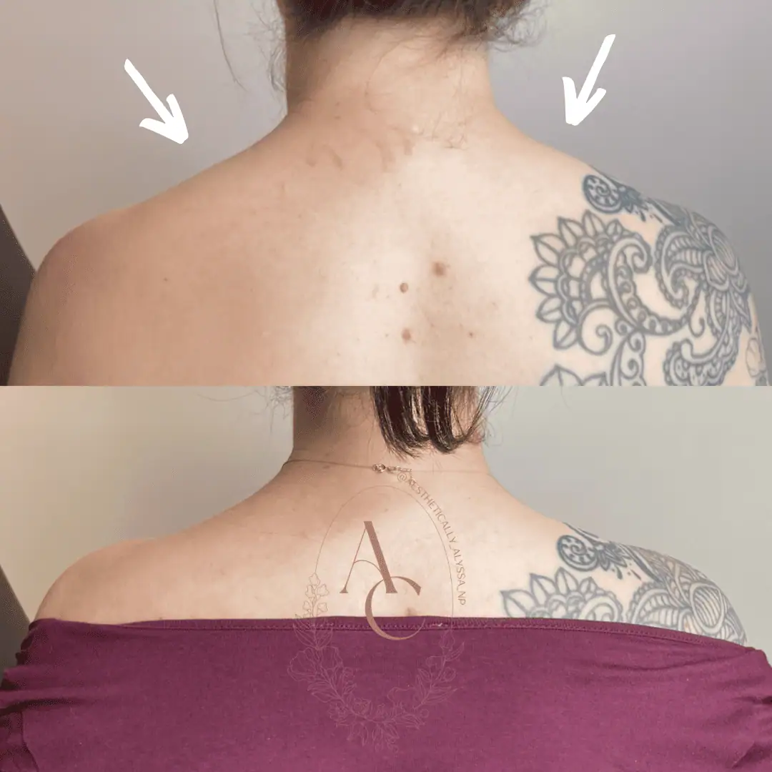 Trapezius-Tox-before-after-ones-in-New-York