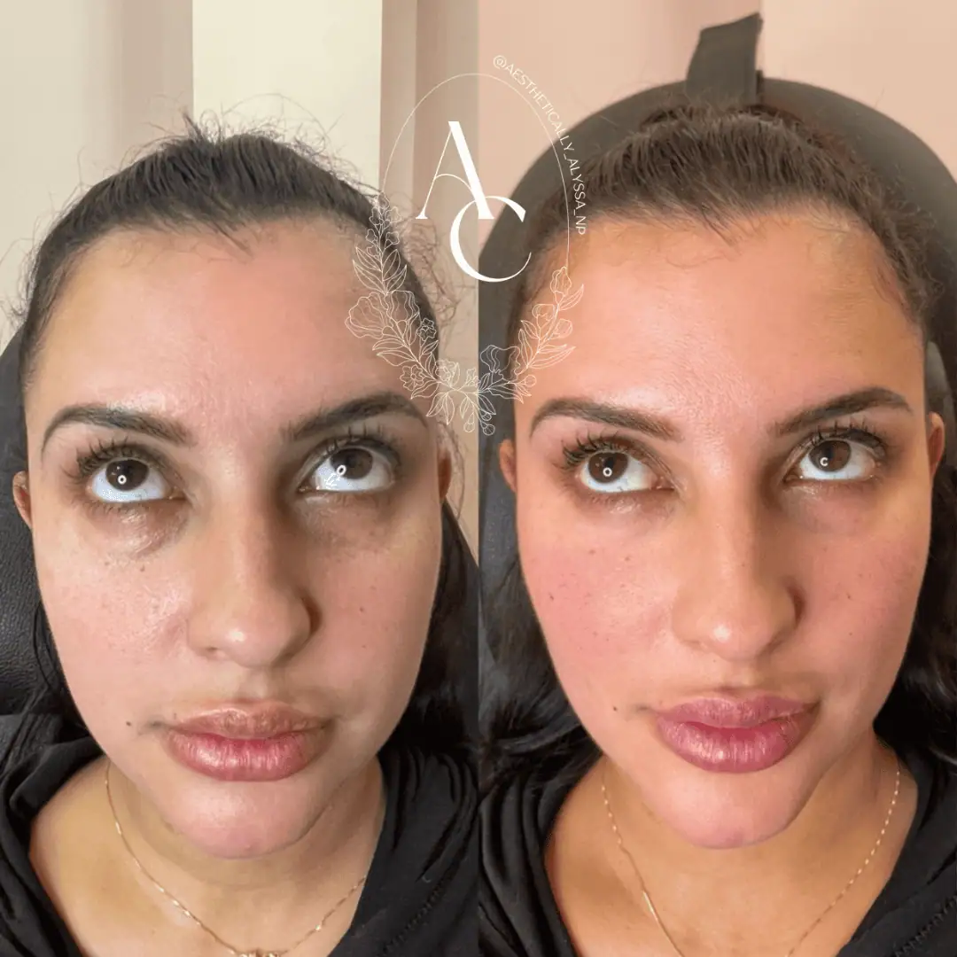 Undereye-Filler-PRP-before-after-seven-in-New-York