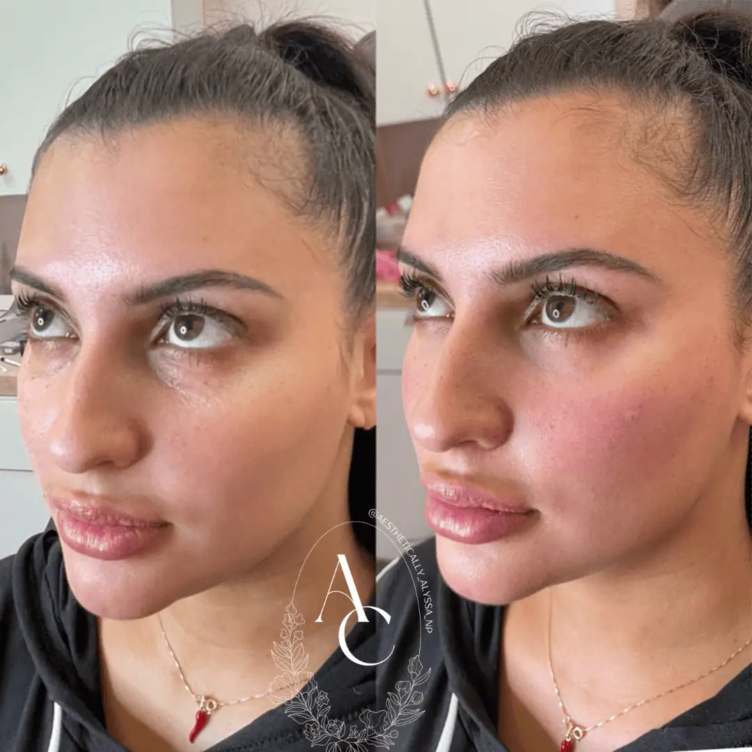 Undereye-Filler-PRP-before-after-six-in-New-York