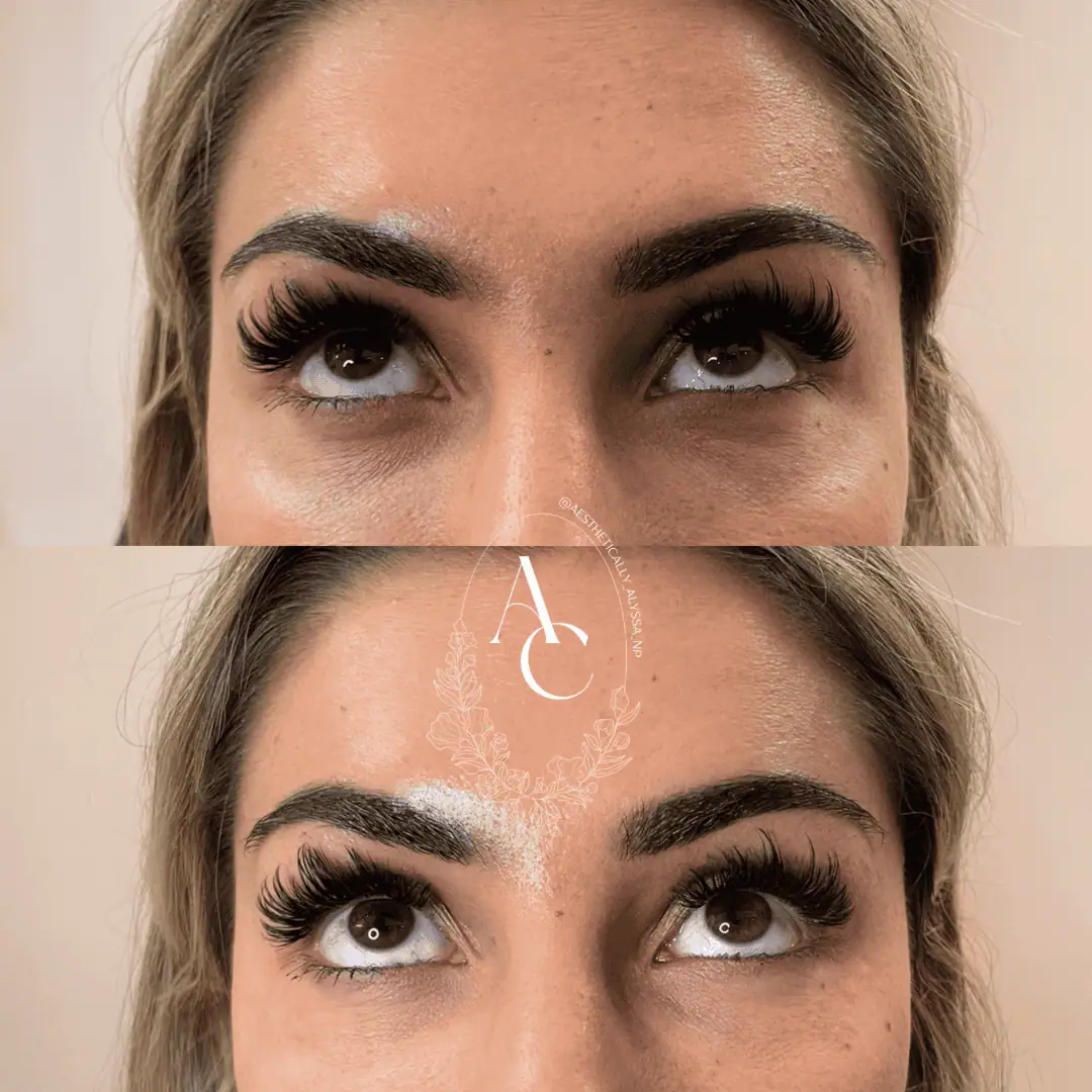 Undereye-Filler-PRP-before-after-three-in-New-York