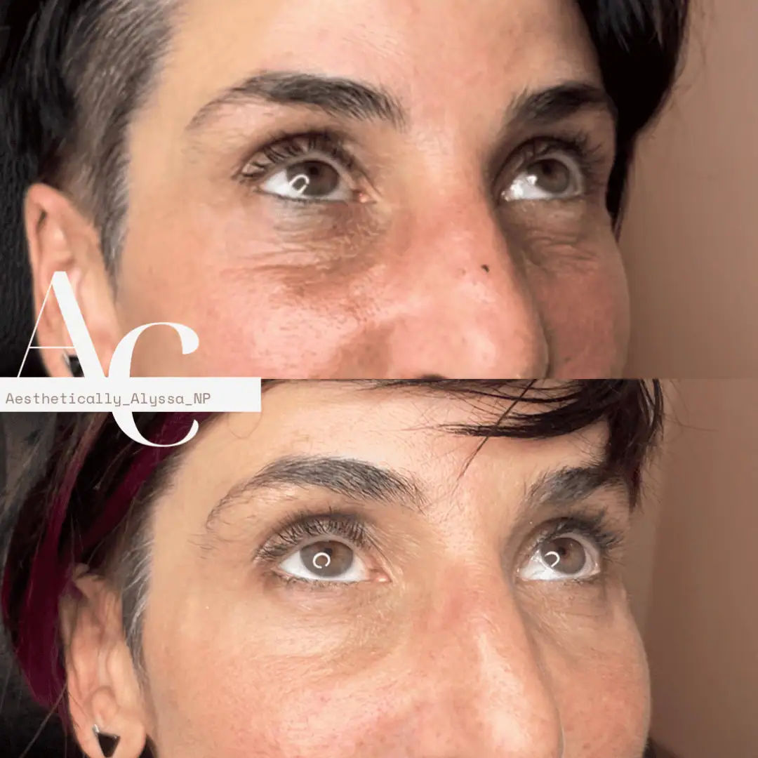 Undereye-Filler-PRP-before-after-two-in-New-York