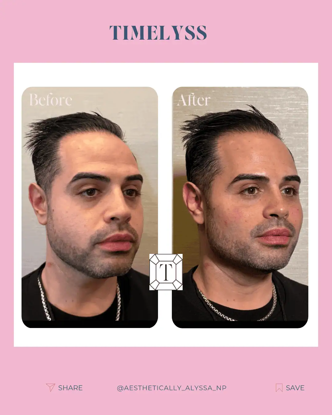 cheek-filler-before-after-seventeen-in-new-york