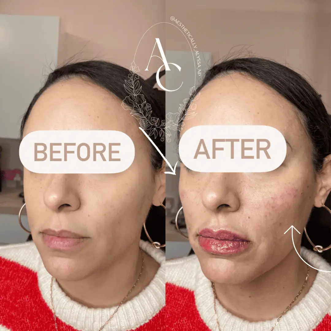 cheek-filler-before-after-six-in-new-york
