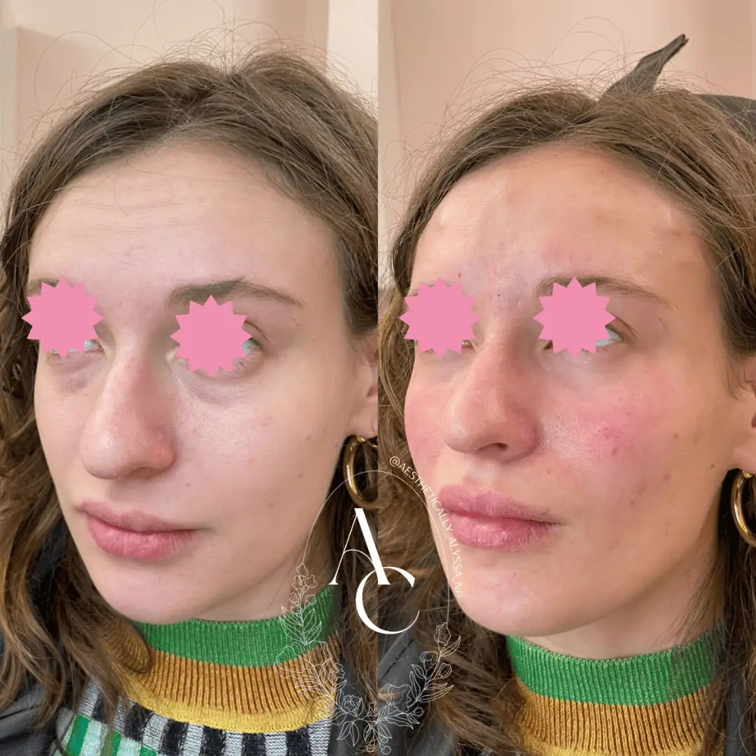 cheek-filler-before-after-three-in-new-york