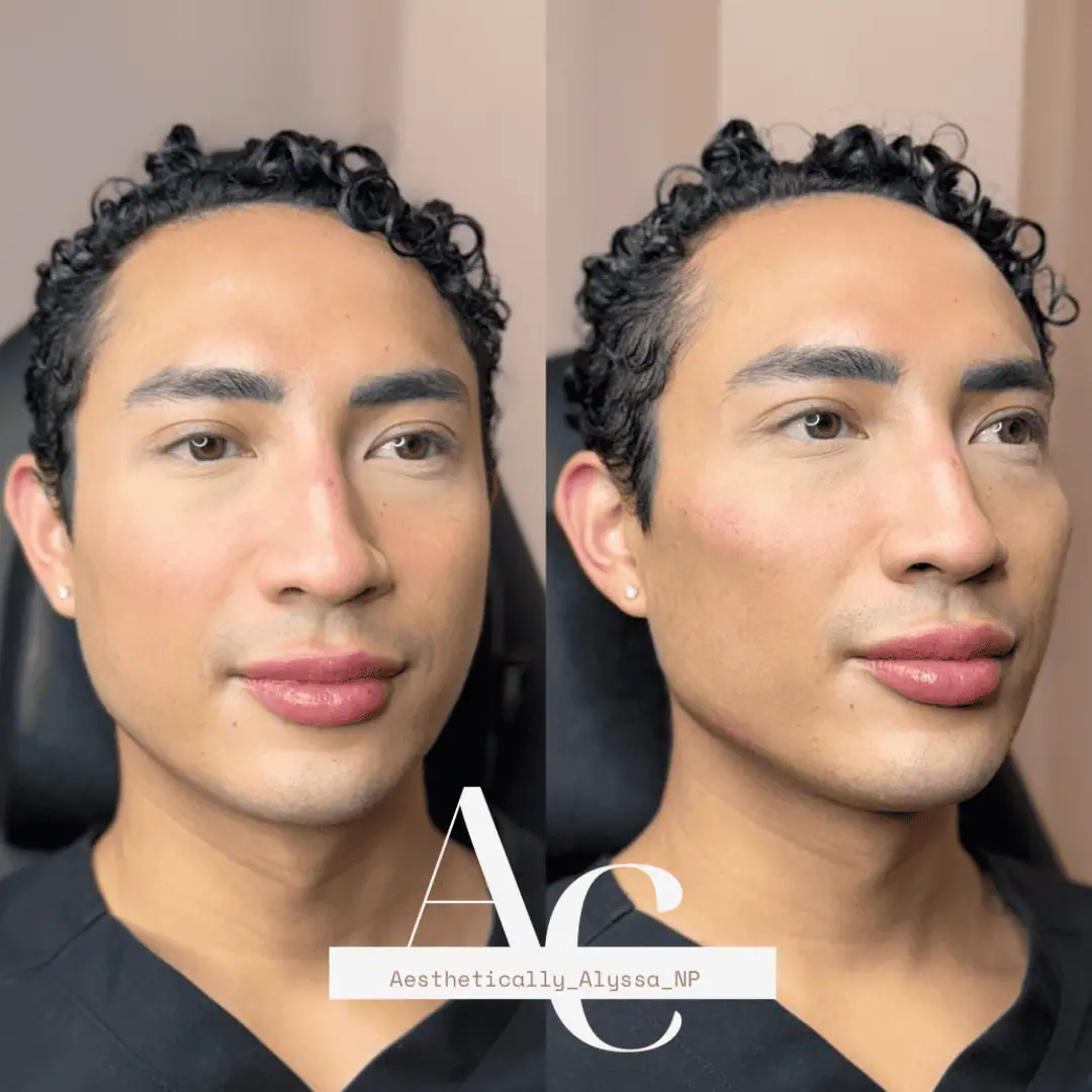 cheek-filler-before-after-twenty-eight-in-new-york
