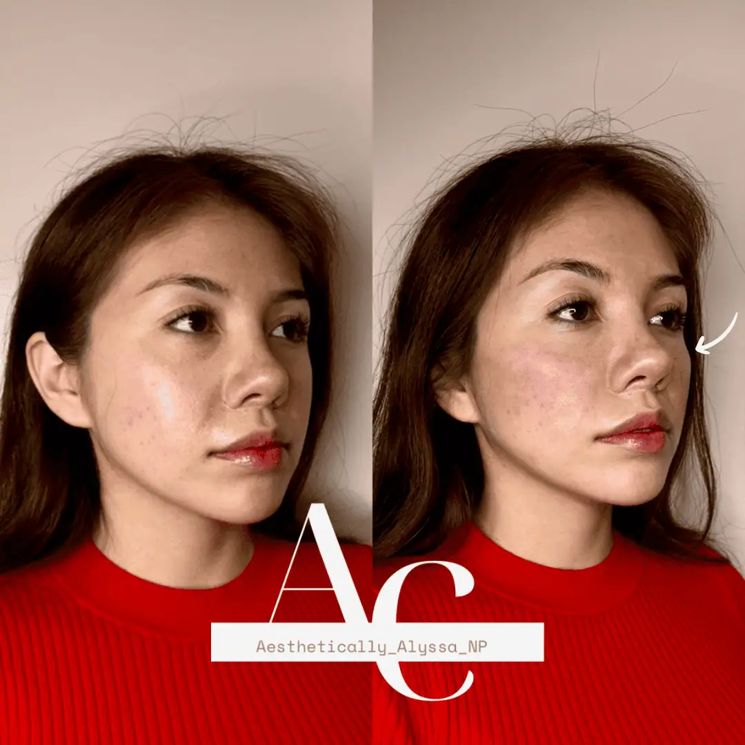 cheek-filler-before-after-twenty-seven-in-new-york