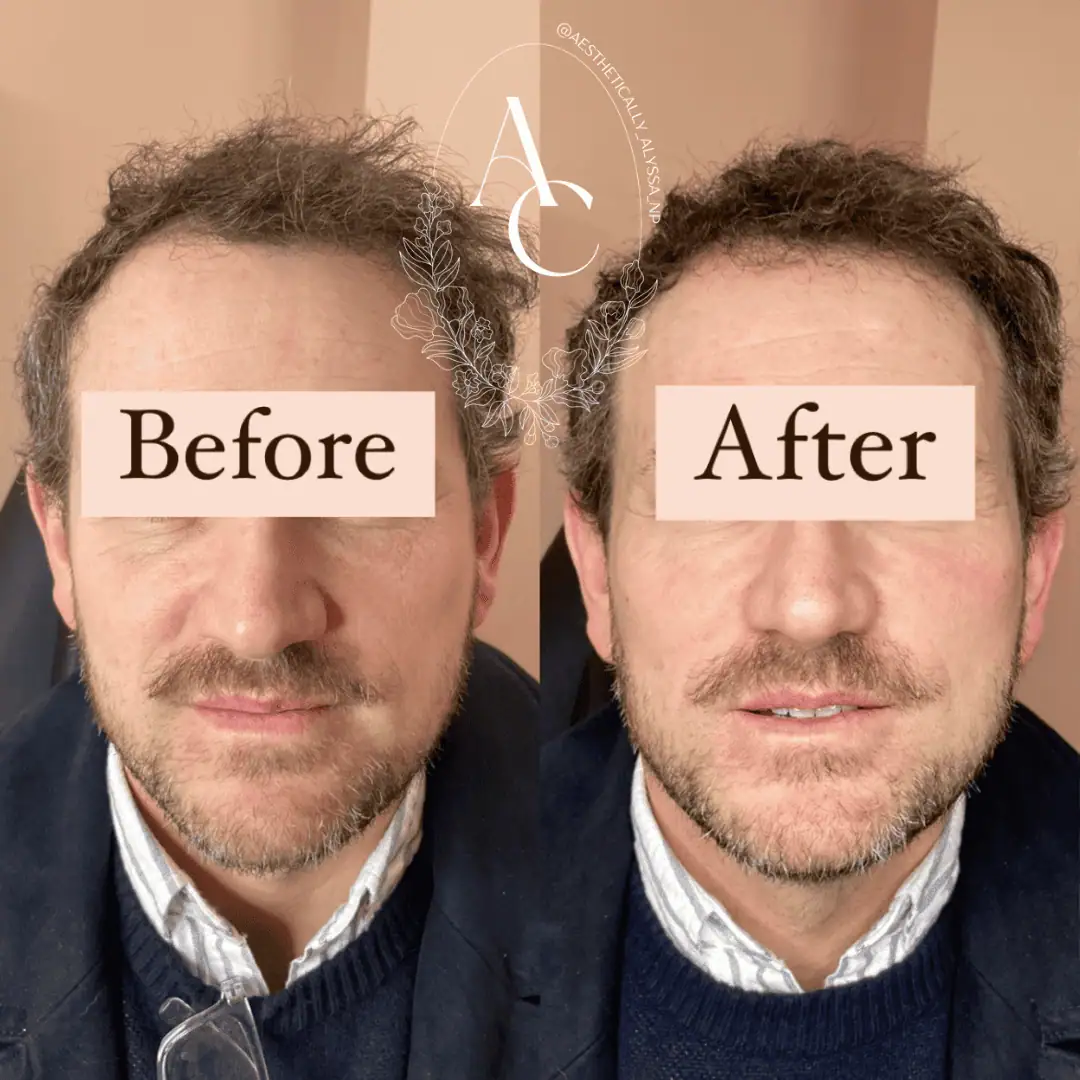 cheek-filler-before-after-two-in-new-york
