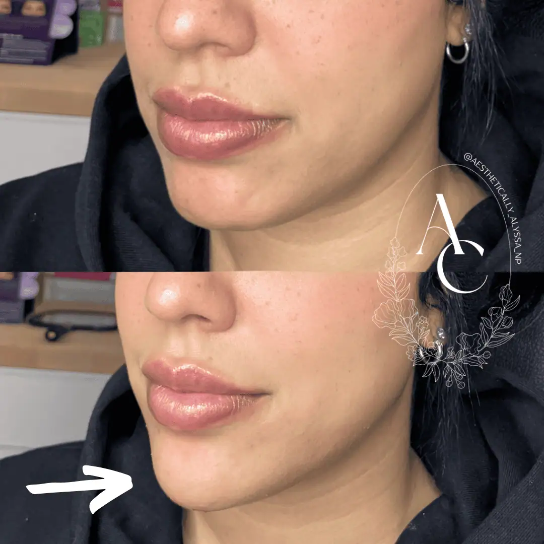 chin-filler-before-after-eighteen-in-new-york