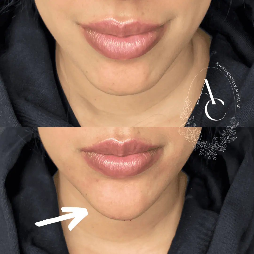 chin-filler-before-after-fourteen-in-new-york