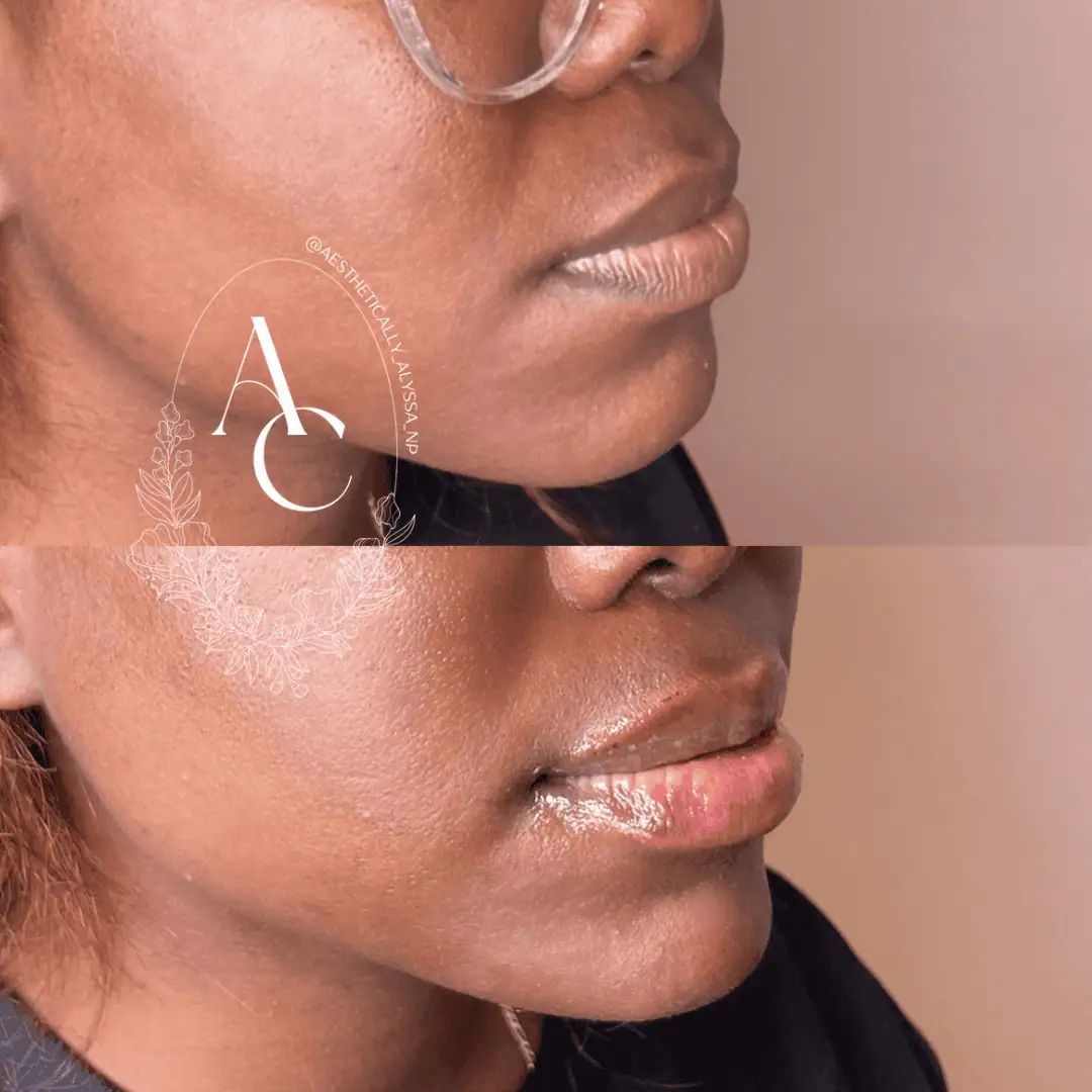 chin-filler-before-after-one-in-new-york