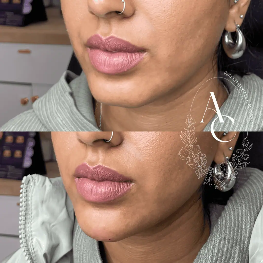 chin-filler-before-after-seven-in-new-york