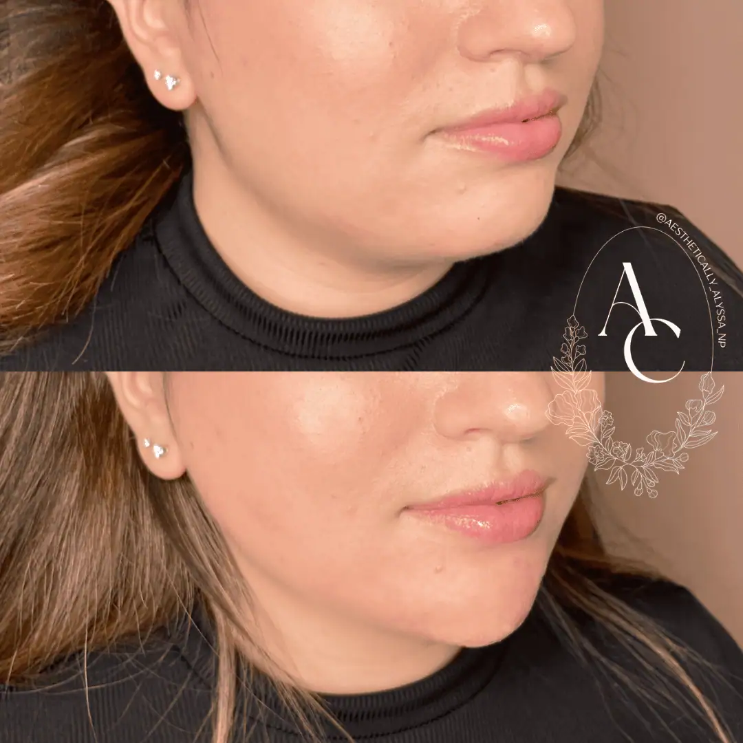 chin-filler-before-after-six-in-new-york