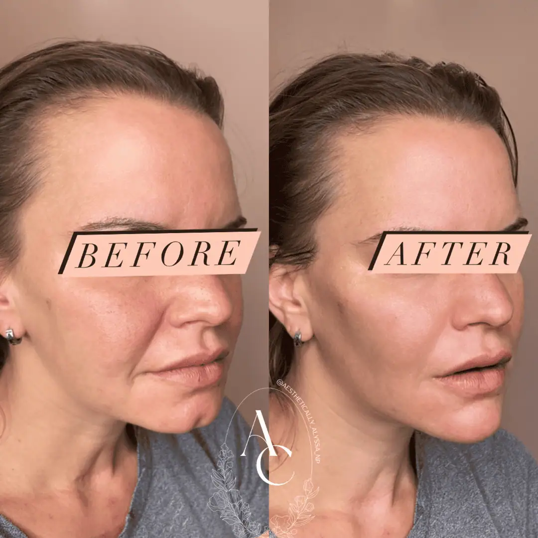 chin-filler-before-after-thirteen-in-new-york