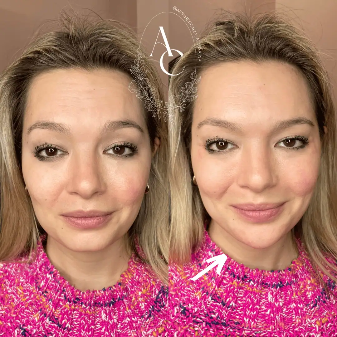 chin-filler-before-after-two-in-new-york