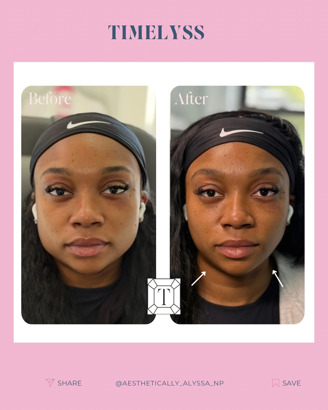 timelyssmedspa-Masseter Botox-Gallery-in-New York, NY