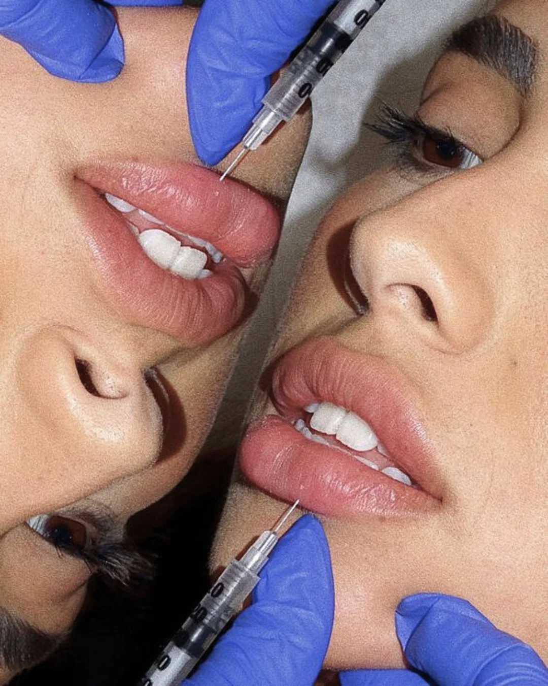 Lip Enhancement Treatment in New York | Timelyss Med Spa
