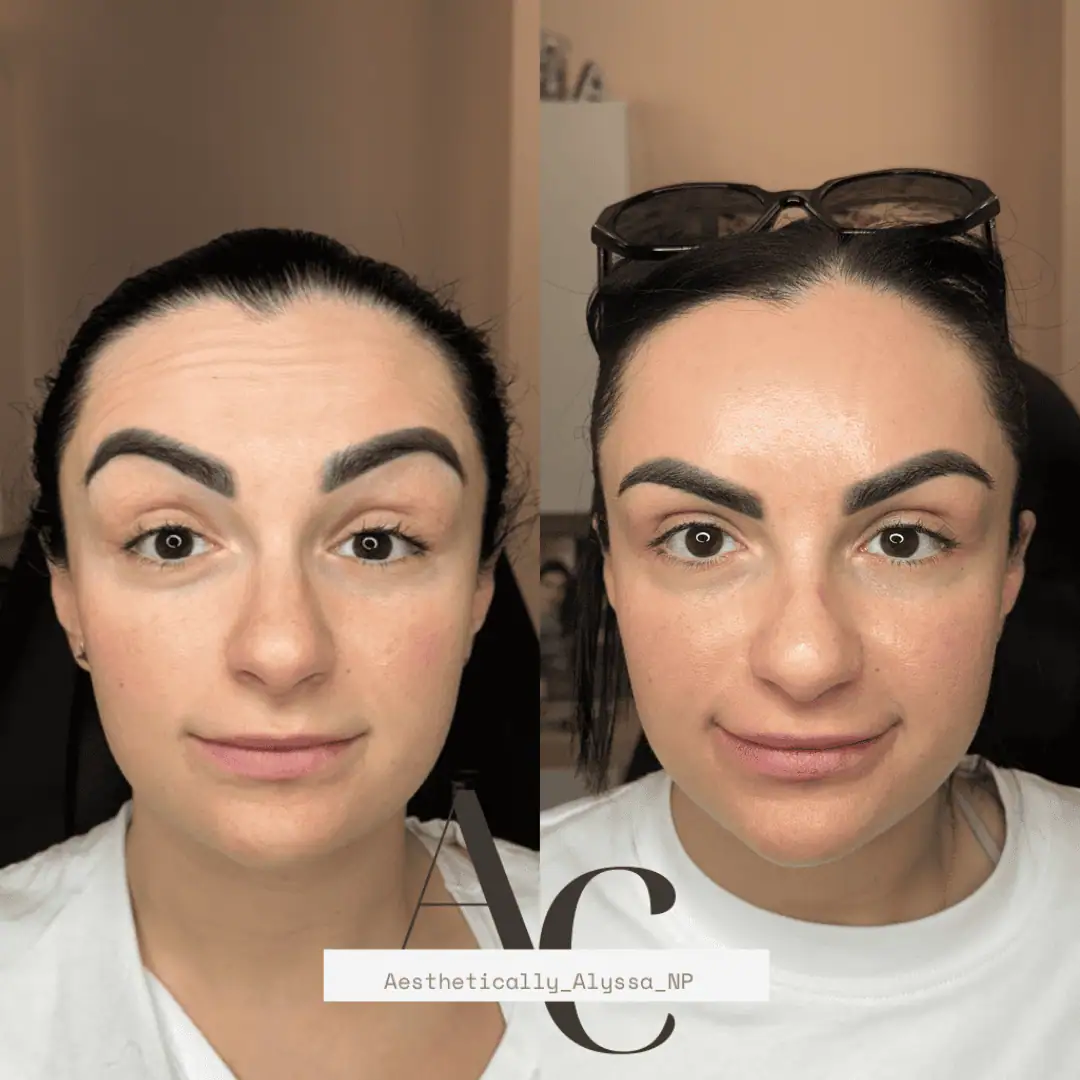 Botox Services in New York | Timelyss Med Spa