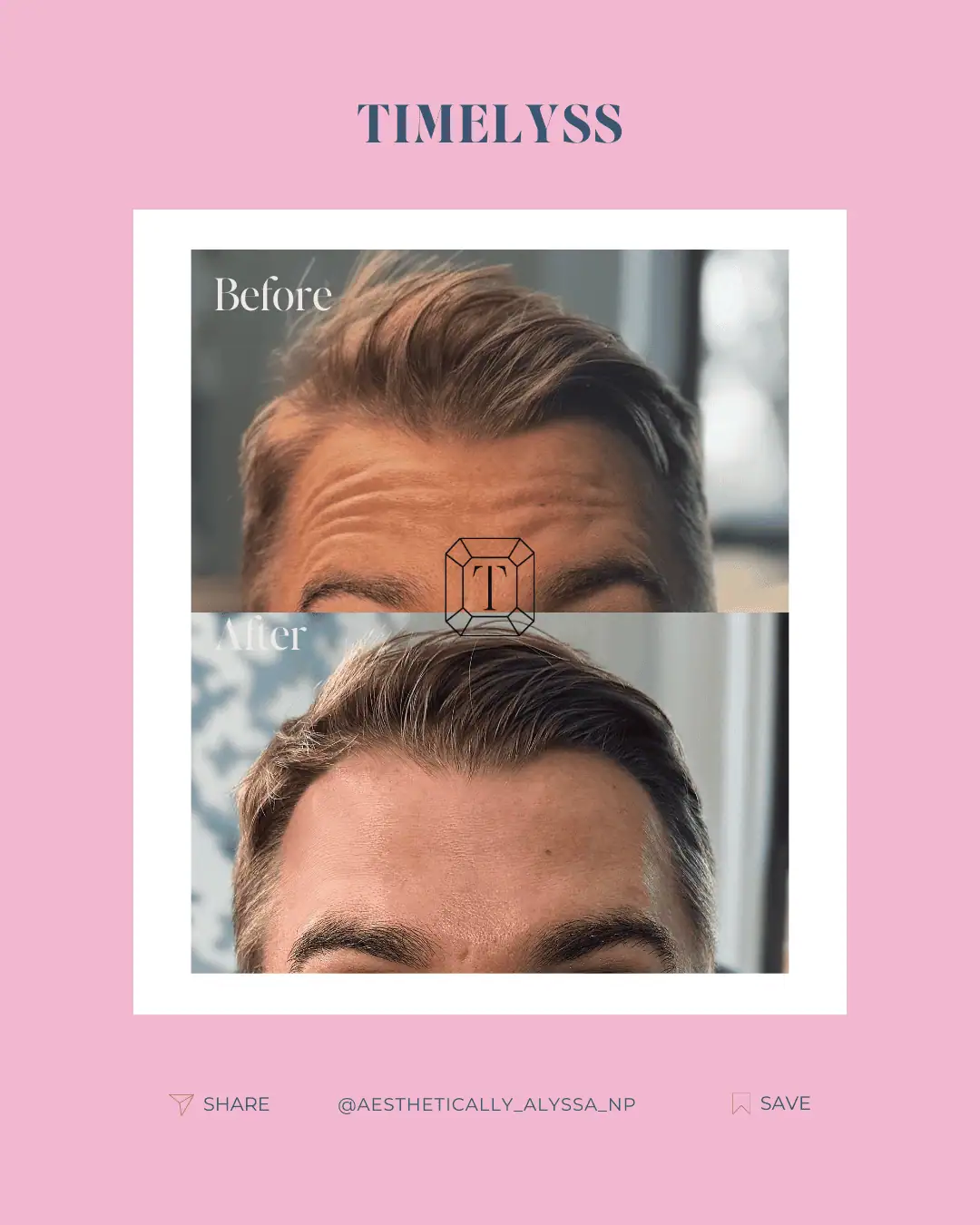 Botox Services in New York | Timelyss Med Spa