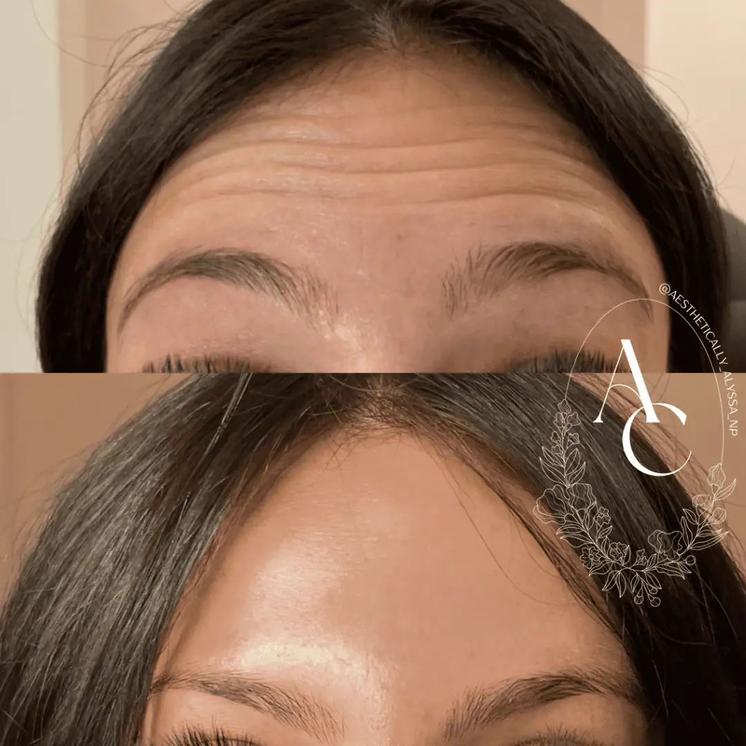 Botox Services in New York | Timelyss Med Spa