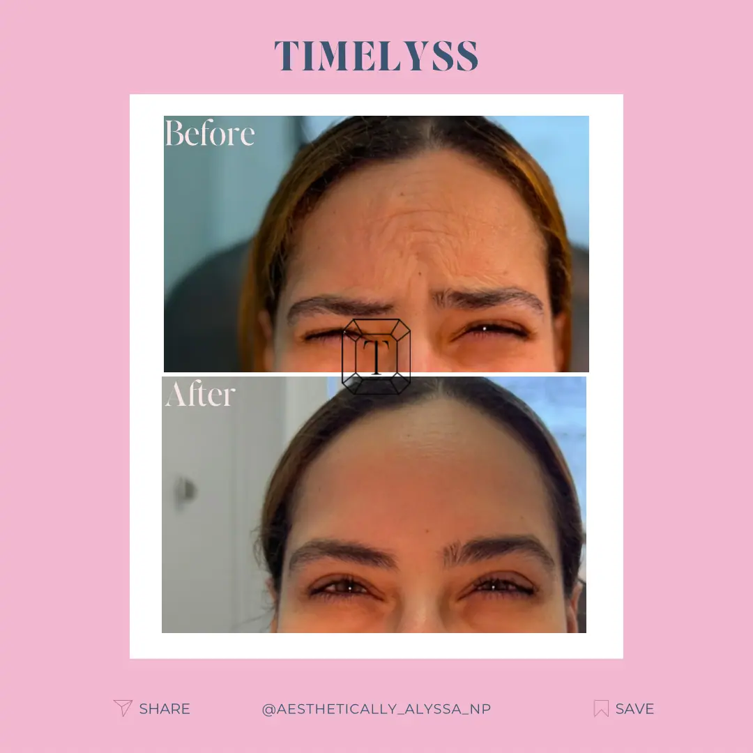 Botox Services in New York | Timelyss Med Spa