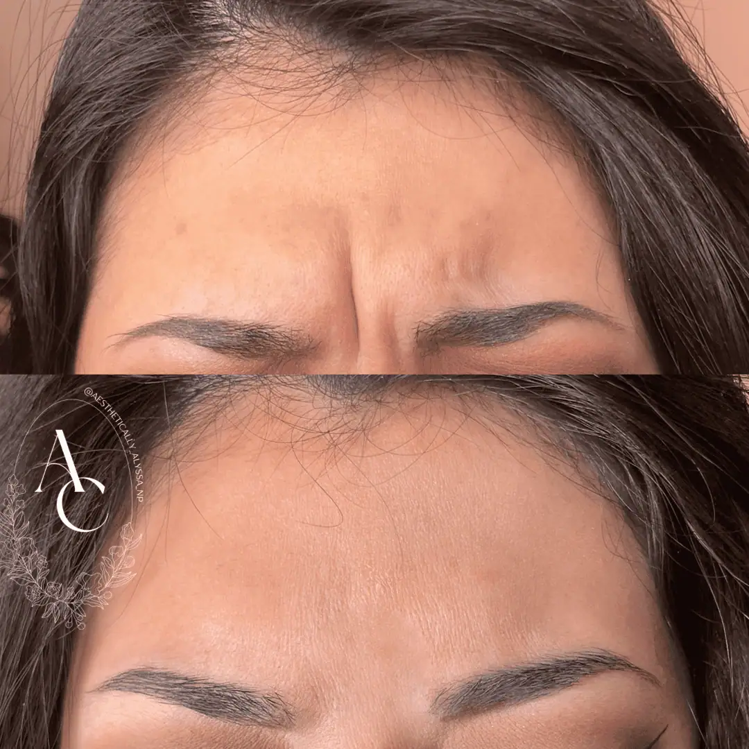 Botox Services in New York | Timelyss Med Spa