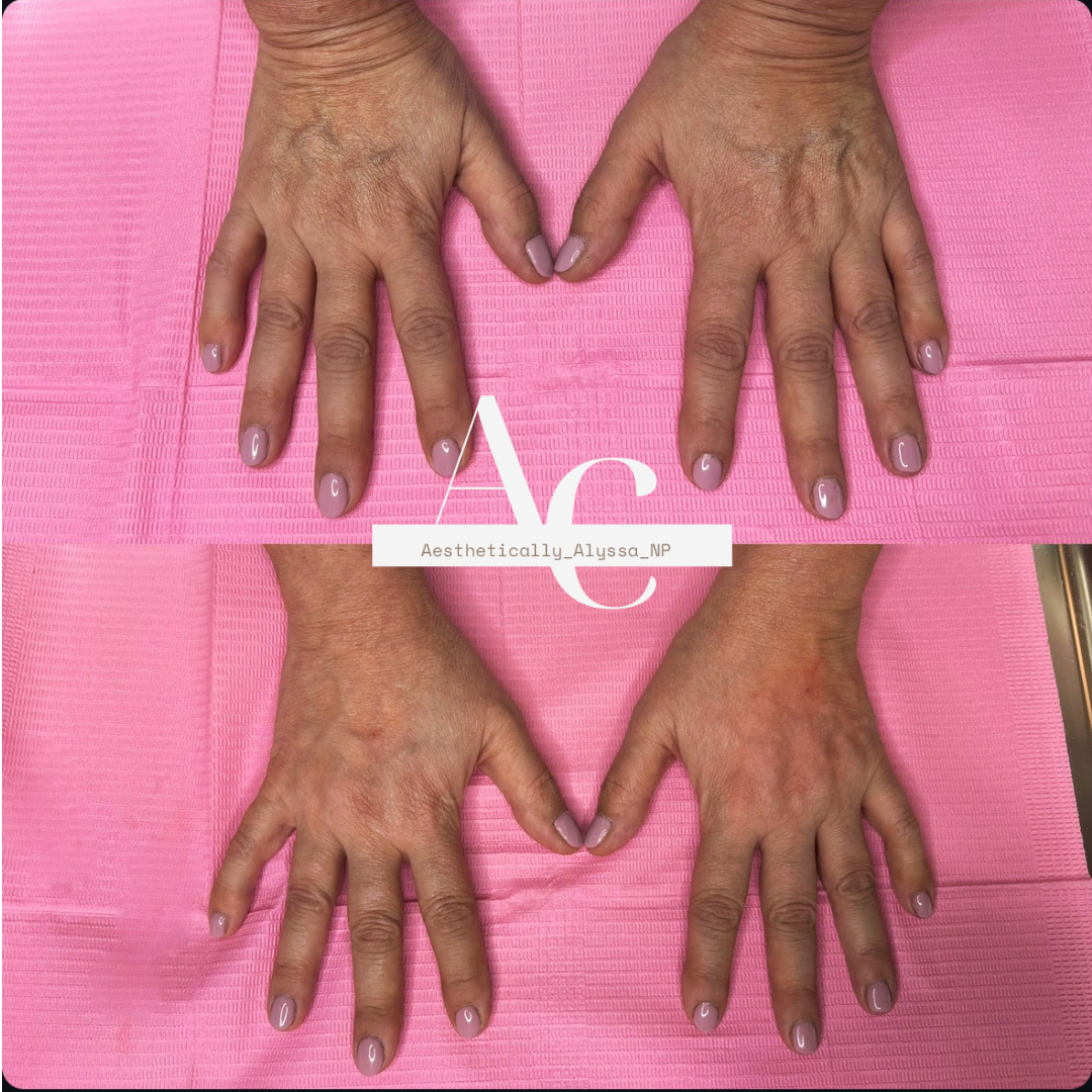 Hand Rejuvenation in New York | Timelyss Med Spa