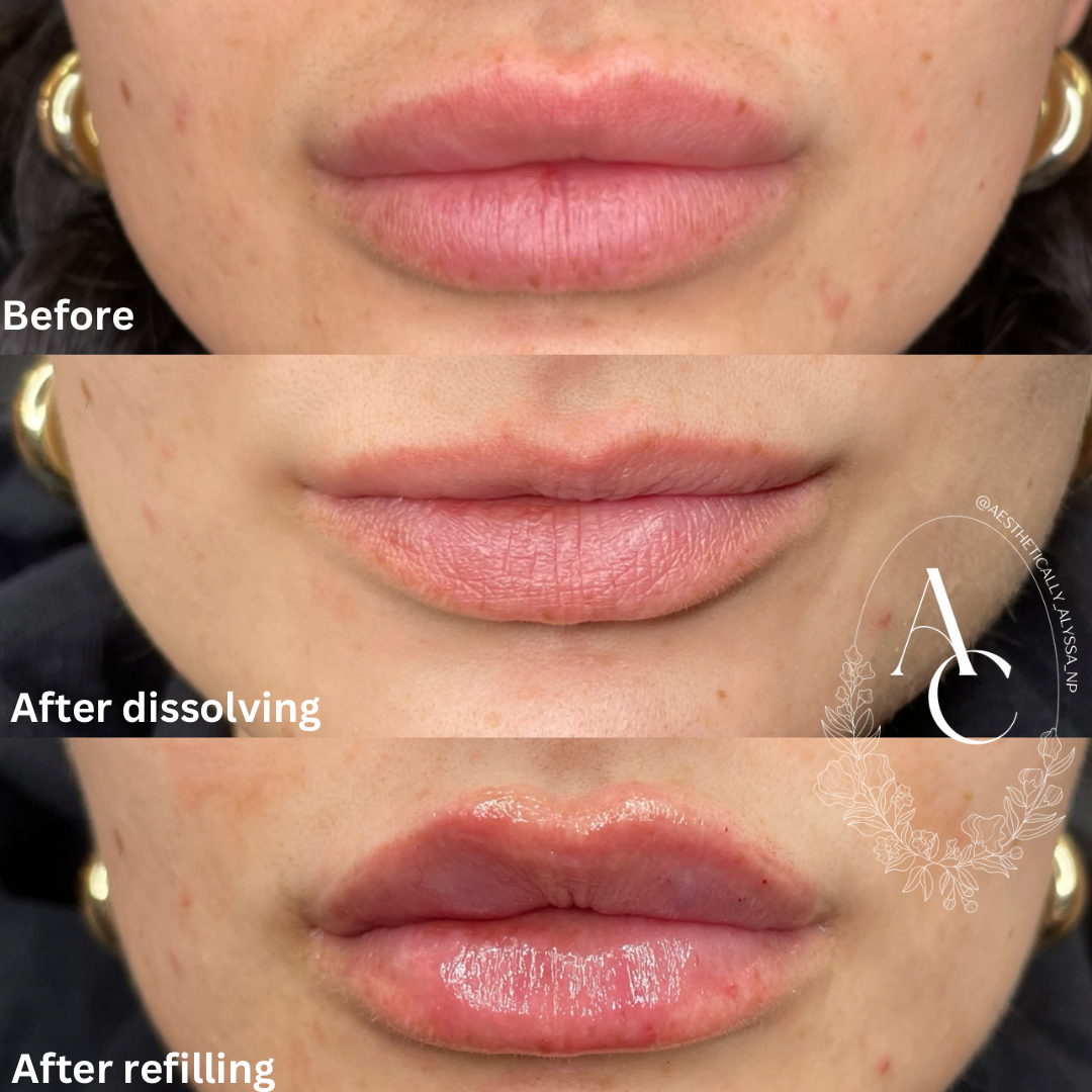 Hylenex in New York | Timelyss Med Spa