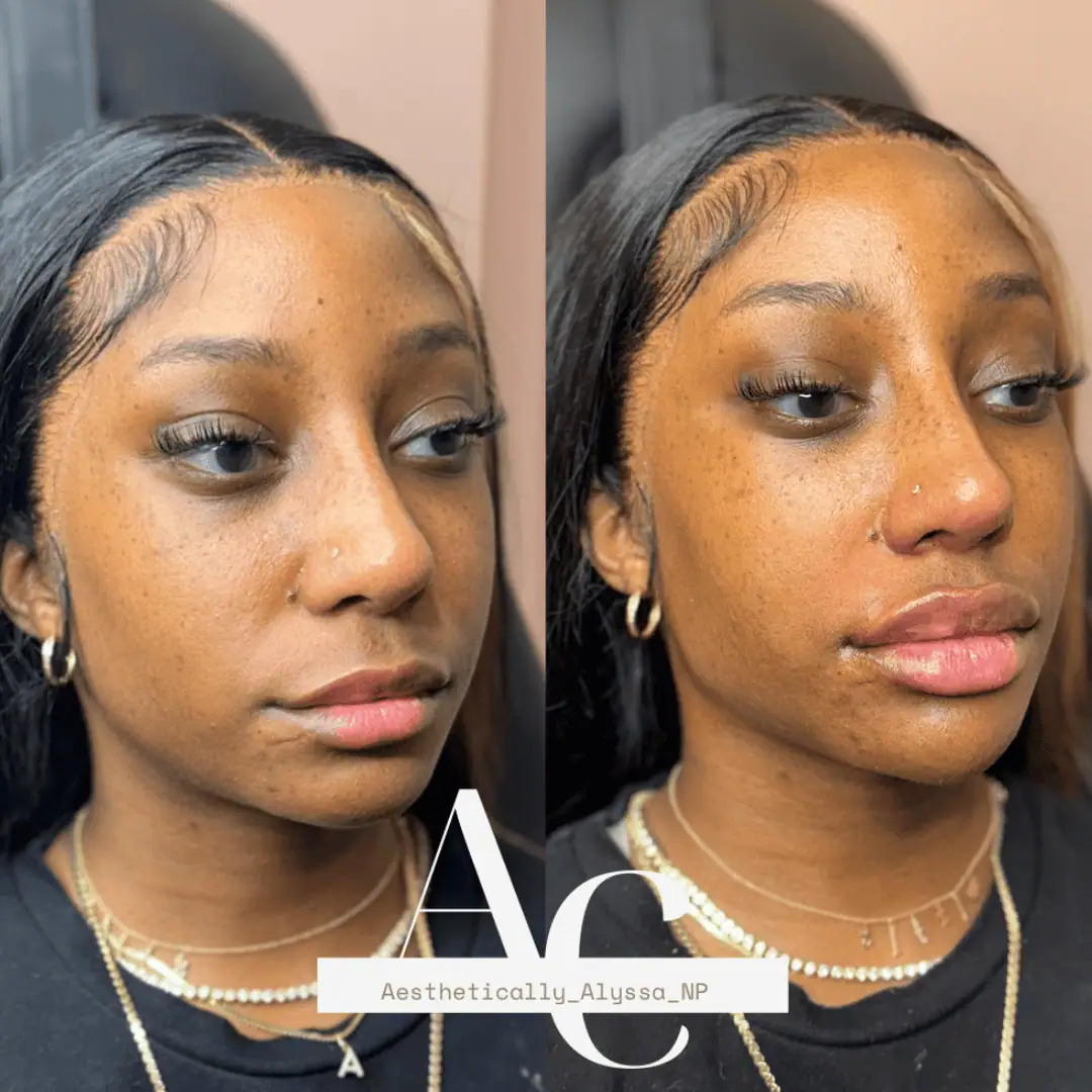 Jawline Filler in New York | Timelyss Med Spa