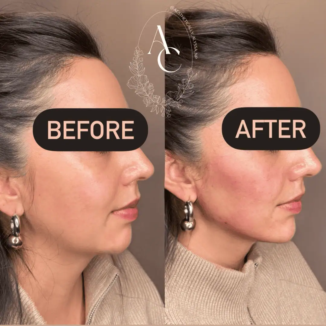 Jawline Filler in New York | Timelyss Med Spa