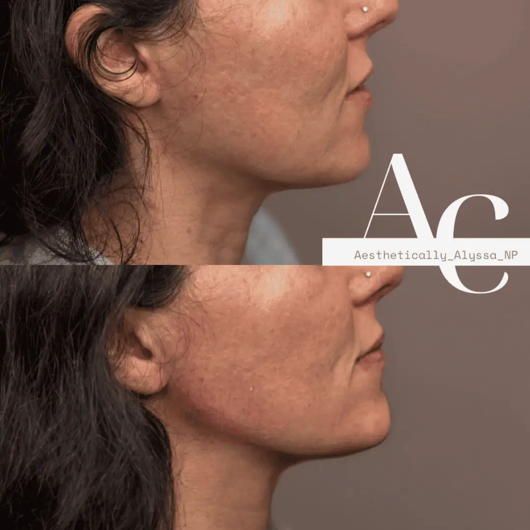 Jawline Filler in New York | Timelyss Med Spa