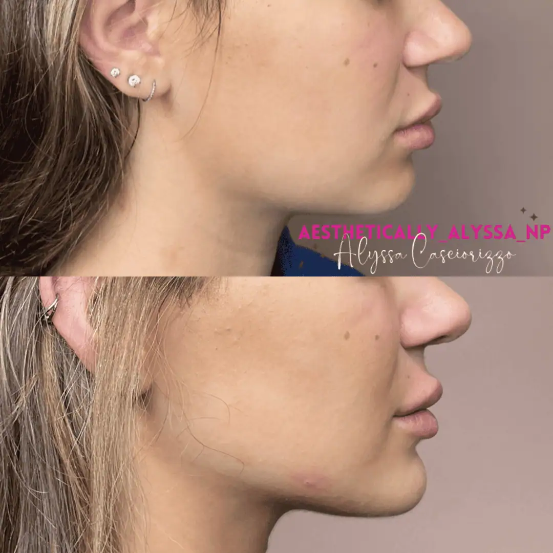 Jawline Filler in New York | Timelyss Med Spa