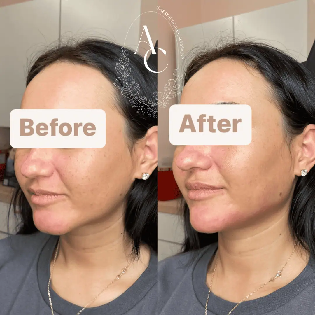 Jawline Filler in New York | Timelyss Med Spa