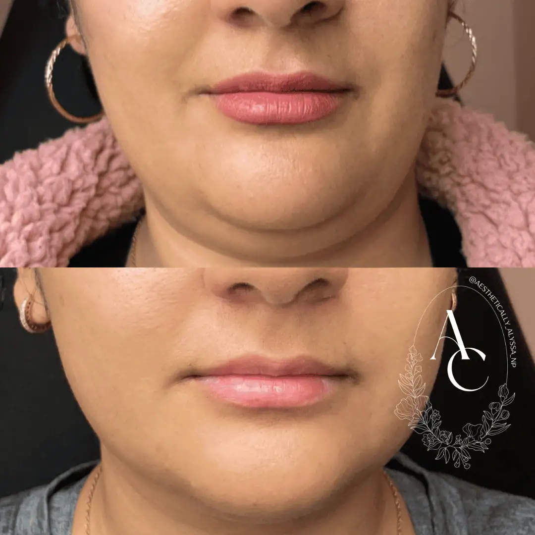 Kybella in New York | Timelyss Med Spa