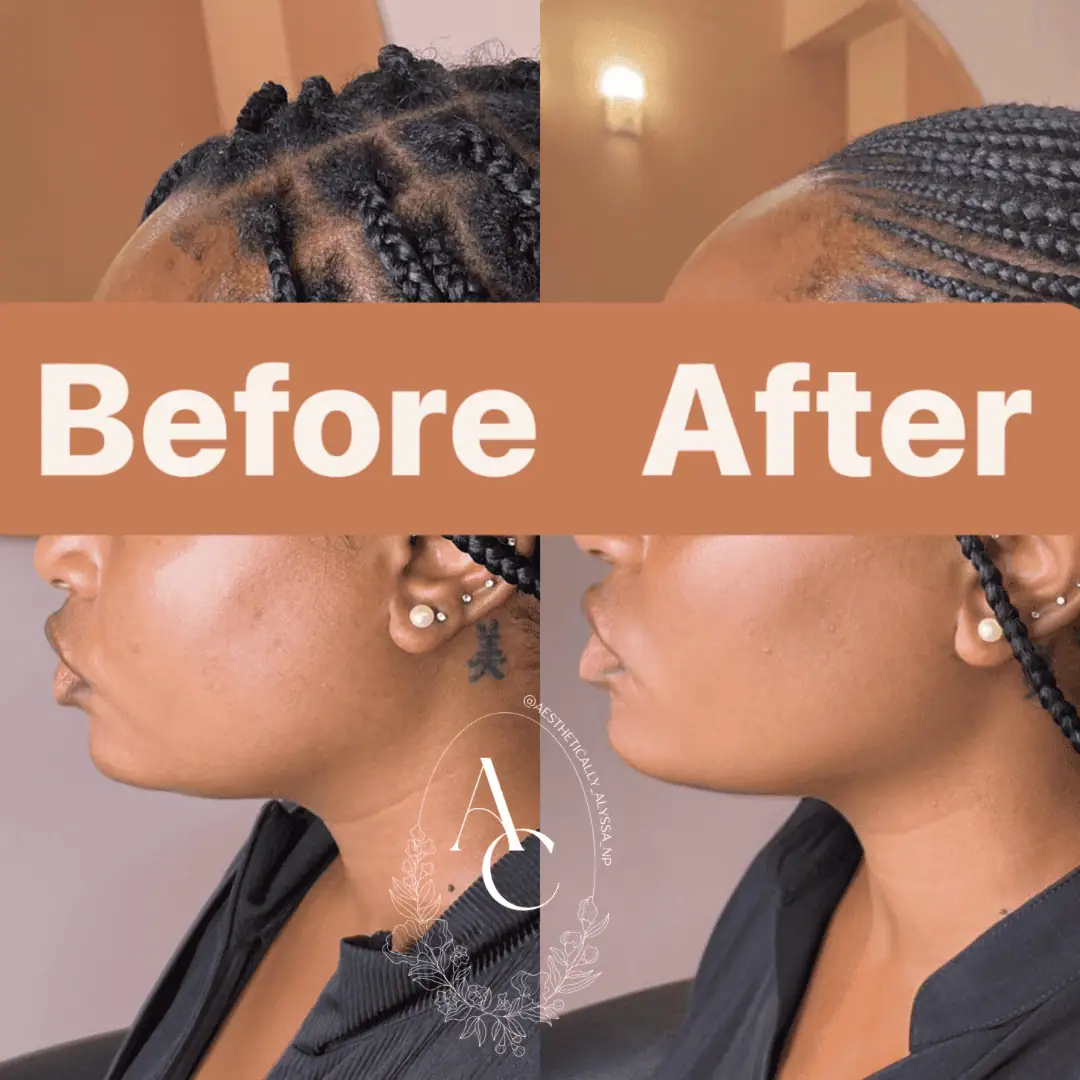 Kybella in New York | Timelyss Med Spa