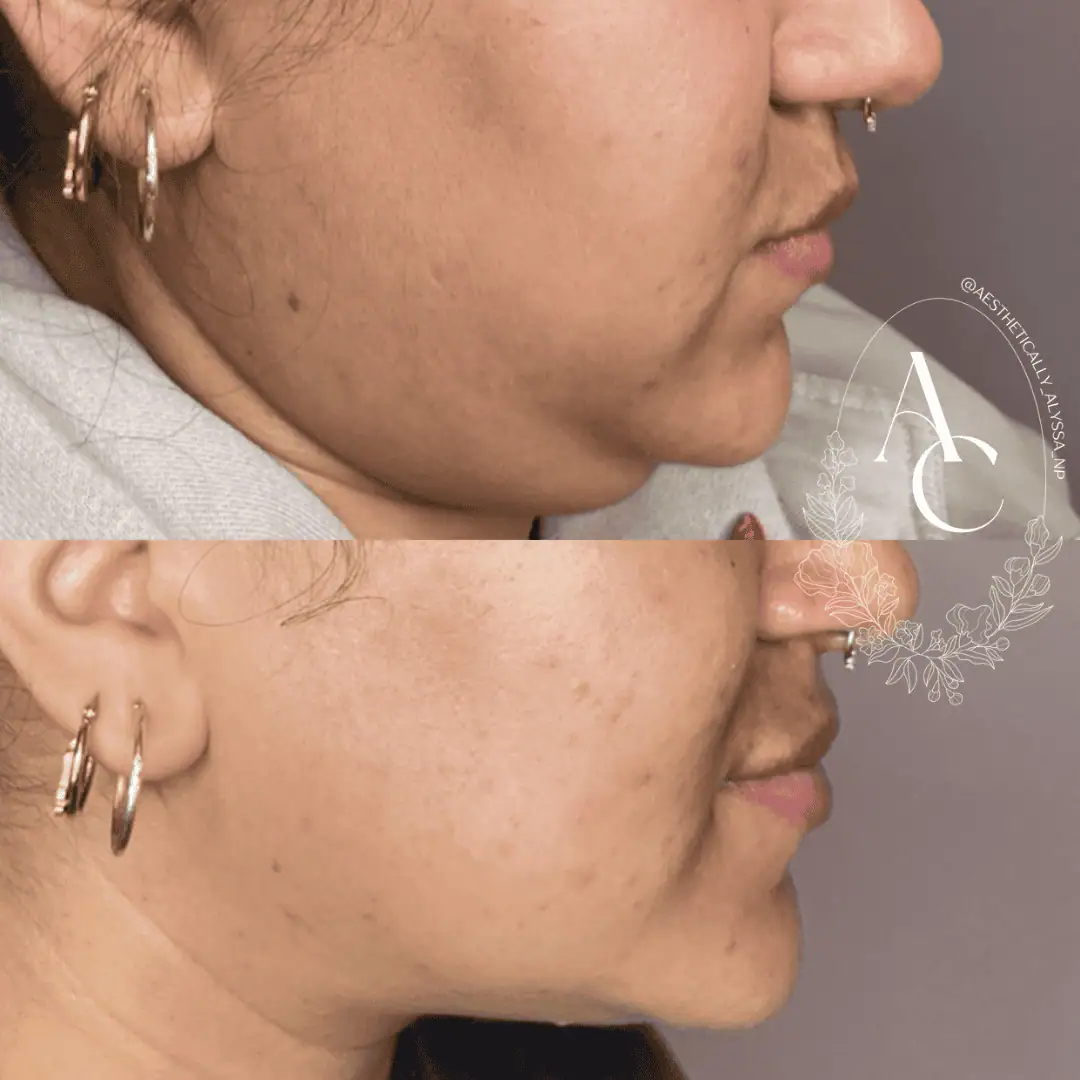 Kybella in New York | Timelyss Med Spa