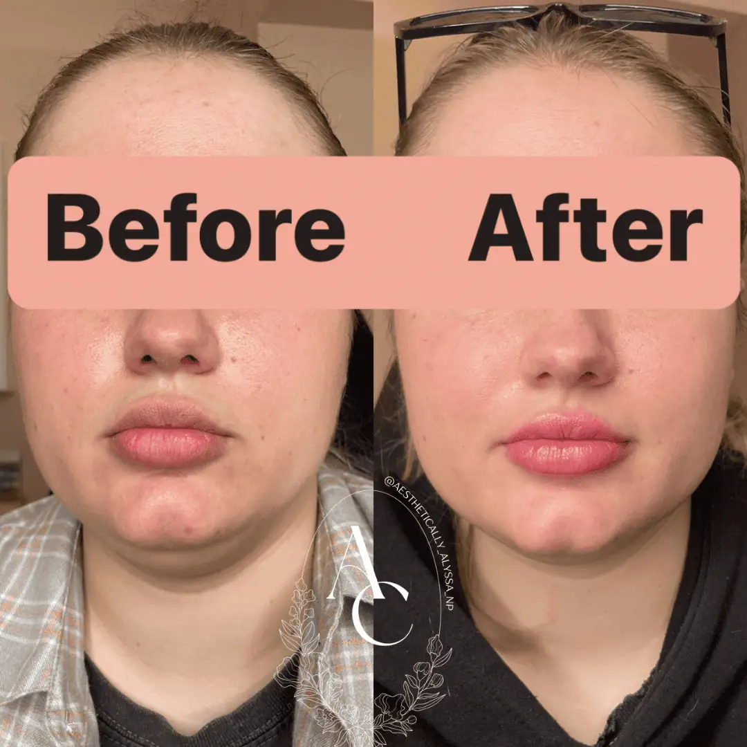 Kybella in New York | Timelyss Med Spa