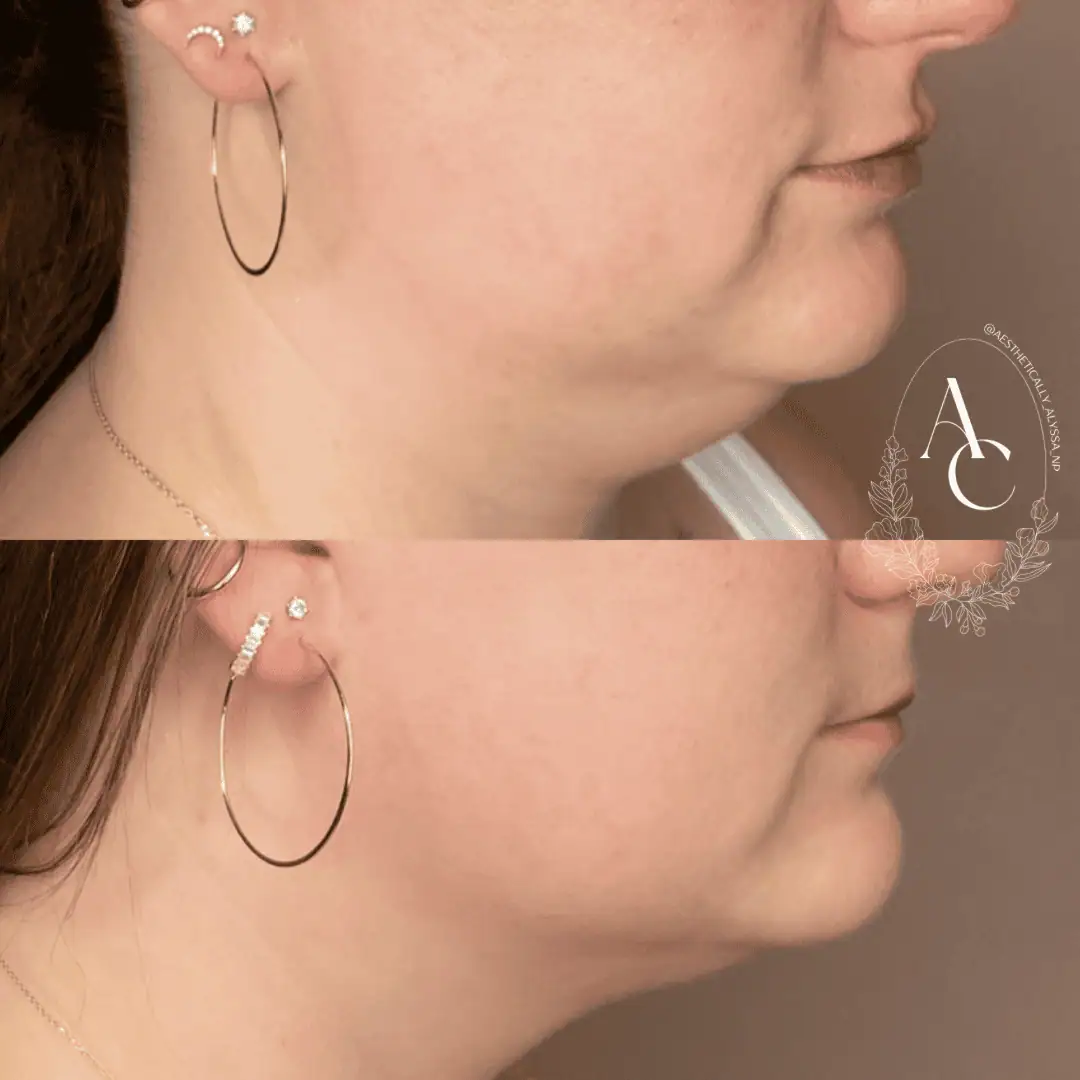 Kybella in New York | Timelyss Med Spa