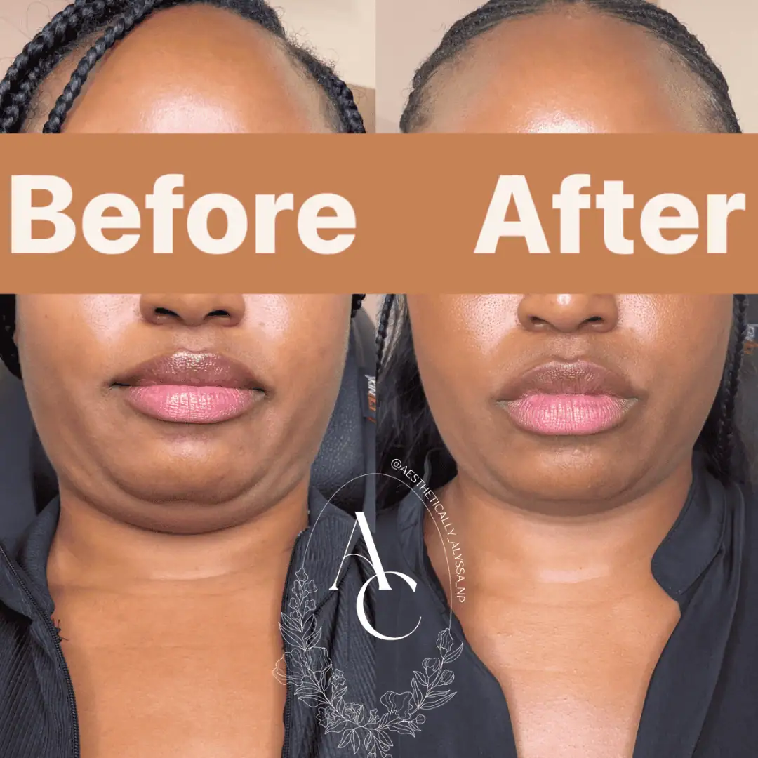 Kybella in New York | Timelyss Med Spa