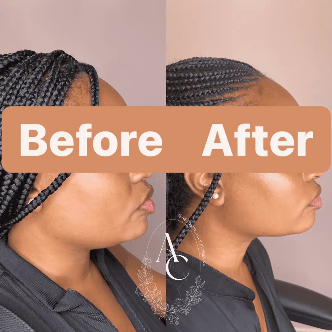 Kybella in New York | Timelyss Med Spa