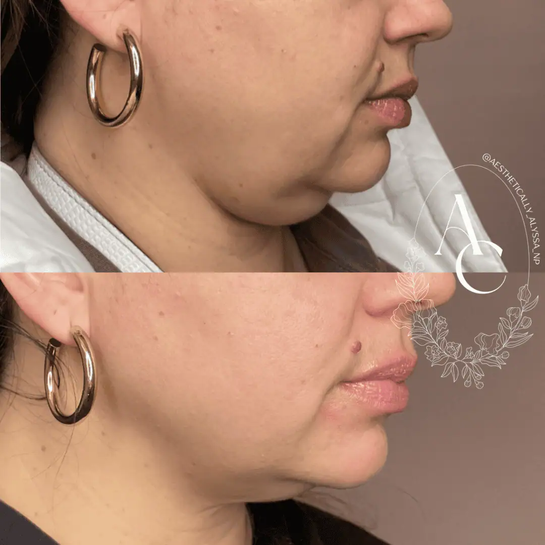 Kybella in New York | Timelyss Med Spa