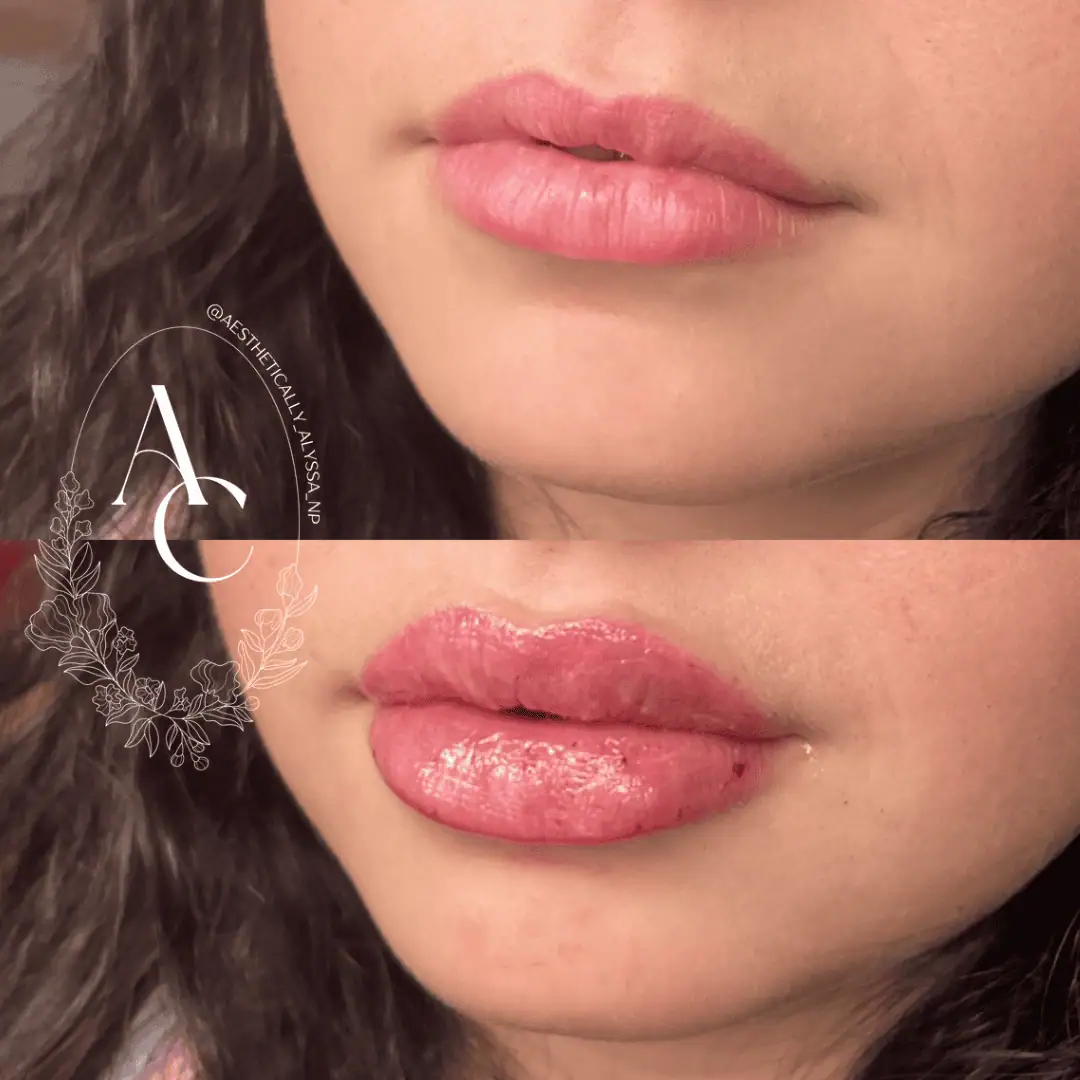 Lip Filler Services in New York by Timelyss Med Spa