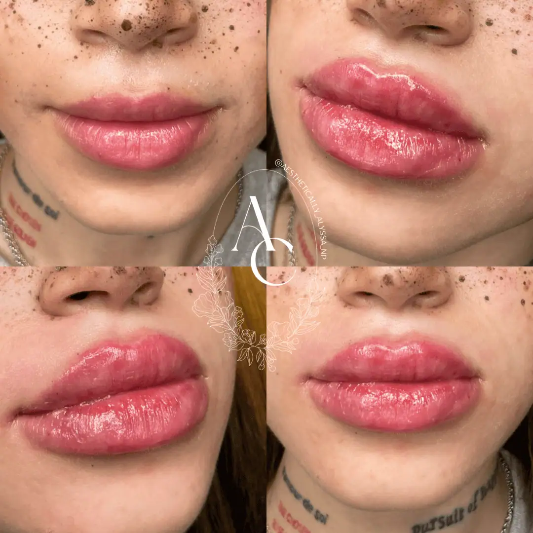 Lip Filler Services in New York by Timelyss Med Spa