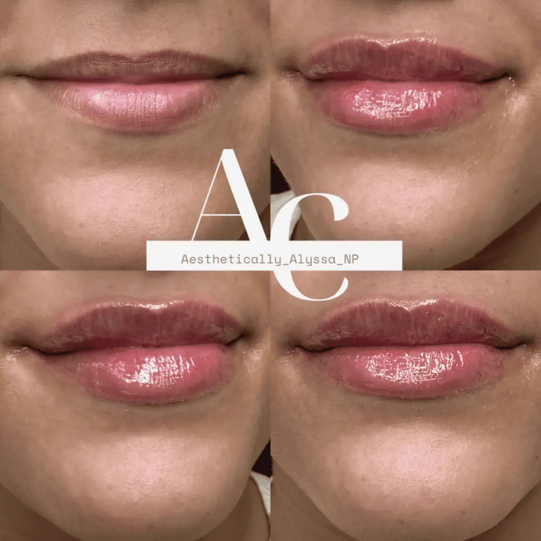 Lip Filler in New York | Timelyss Med Spa