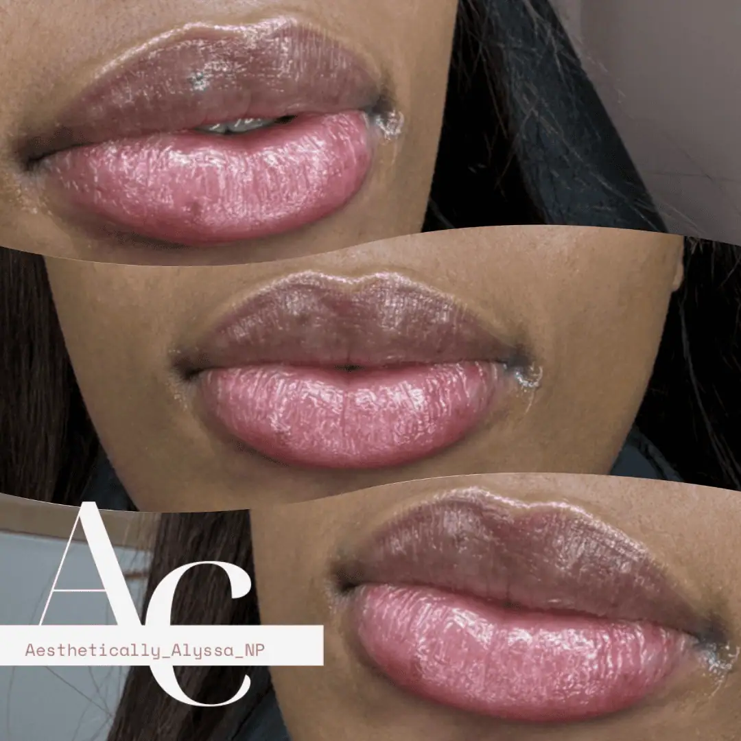 Lip Filler in New York | Timelyss Med Spa